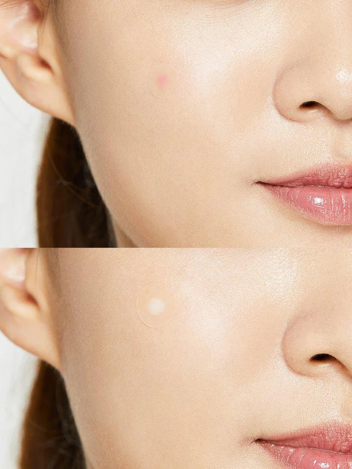 Acne Pimple 24 Master Patch